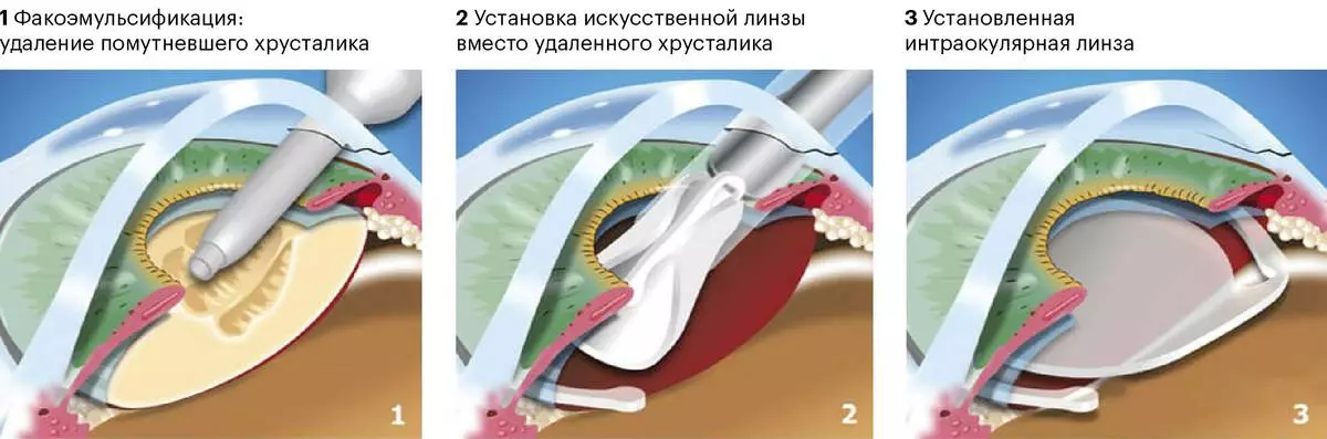 Замена хрусталика что нельзя делать после операции. Этапы операции факоэмульсификации катаракты. Ультразвуковая факоэмульсификация катаракты. Операция ультразвуковая факоэмульсификация катаракты.